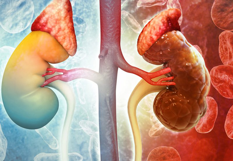 3D-illustration-of-chronic-kidney-disease