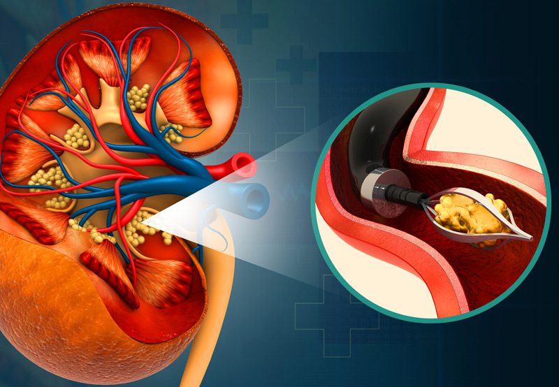3D-illustration-of-kidney-stone-removal-concept 3D-illustration-of-kidney-stone-removal-concept