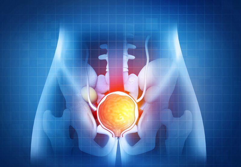 3D-illustration-of-prostate-diseases