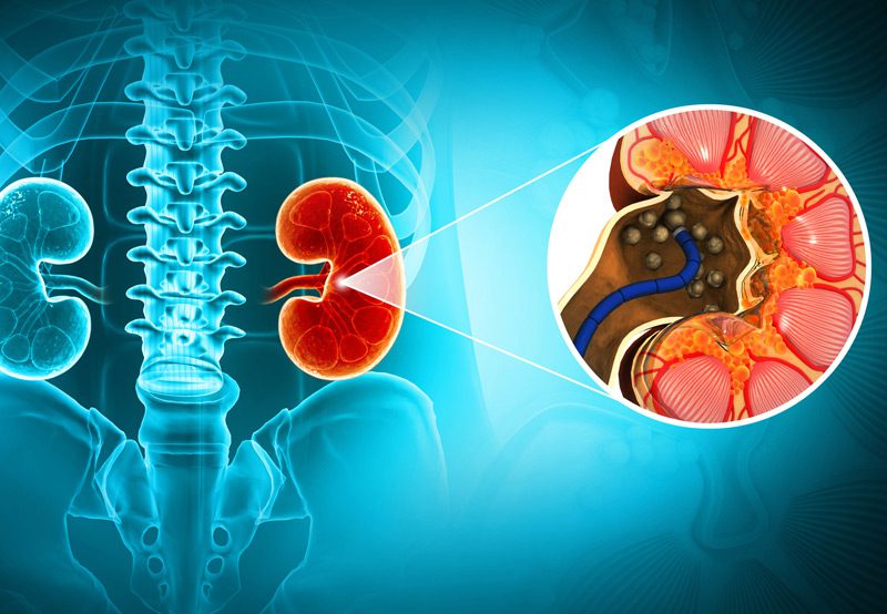 Image-illustrating-kidney-stone-disease