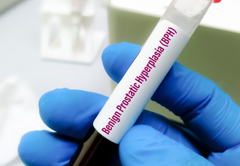 Image-of-blood-sample-for-prostate-health-testing