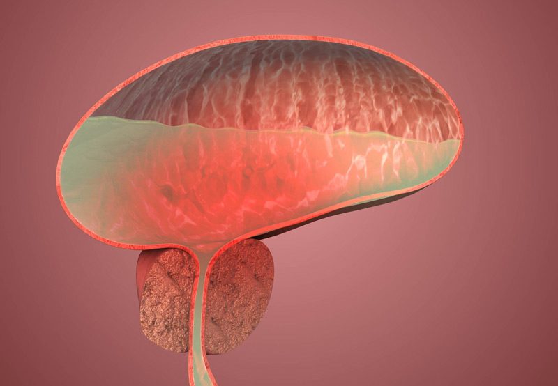Medical-illustration-of-benign-prostate-enlargement