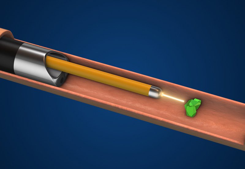 Medical-image-of-ureteroscopy-with-laser-lithotripsy