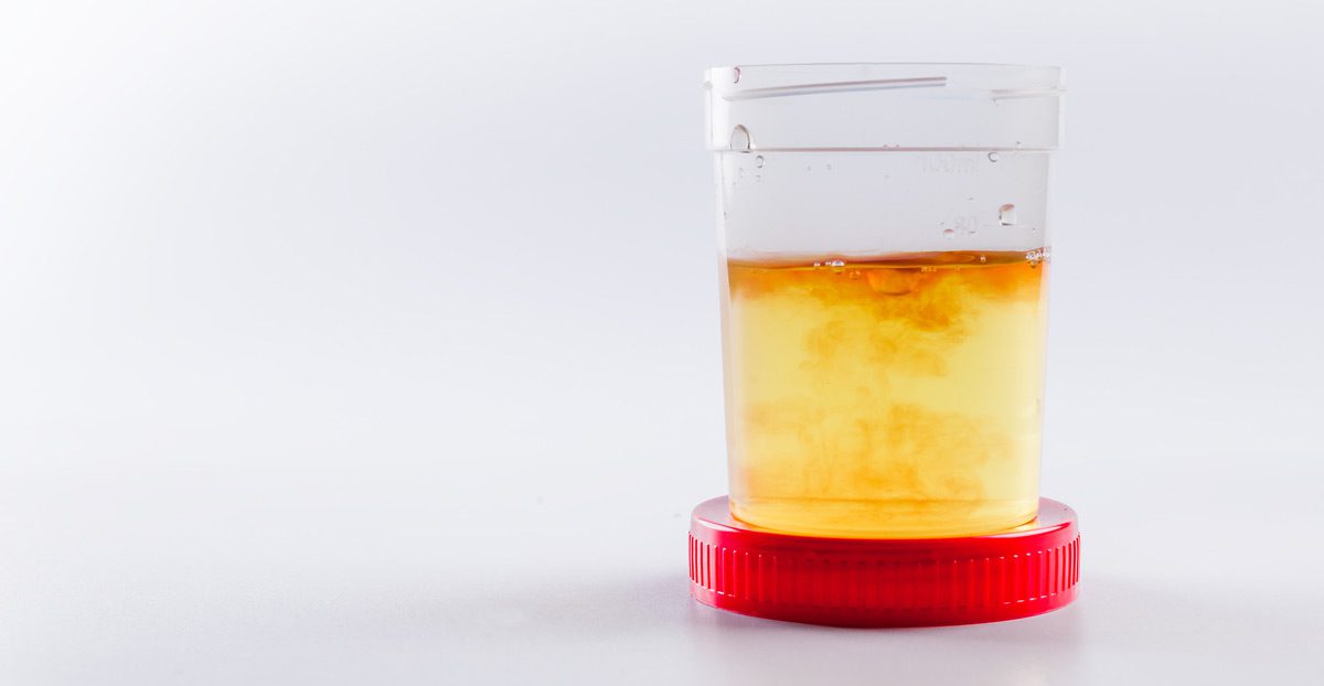 Urine-sample-showing-cloudiness-or-blood-in-sterile-container Urine-sample-showing-cloudiness-or-blood-in-sterile-container