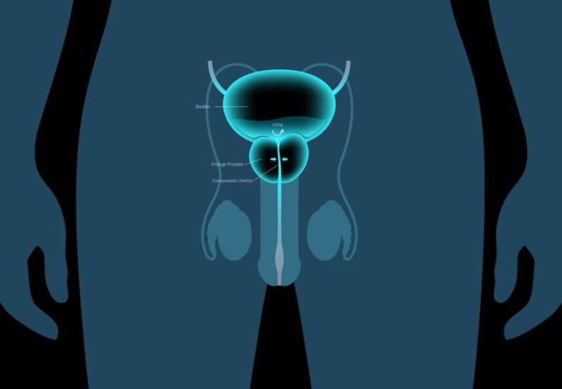 Vector-concept-for-benign-prostatic-hyperplasia