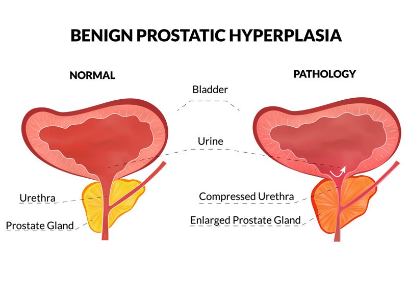 Vector-illustration-of-benign-prostatic-hyperplasia