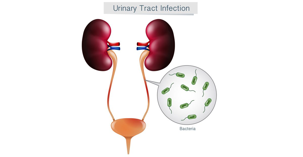 Vector-illustration-of-urinary-tract-infection