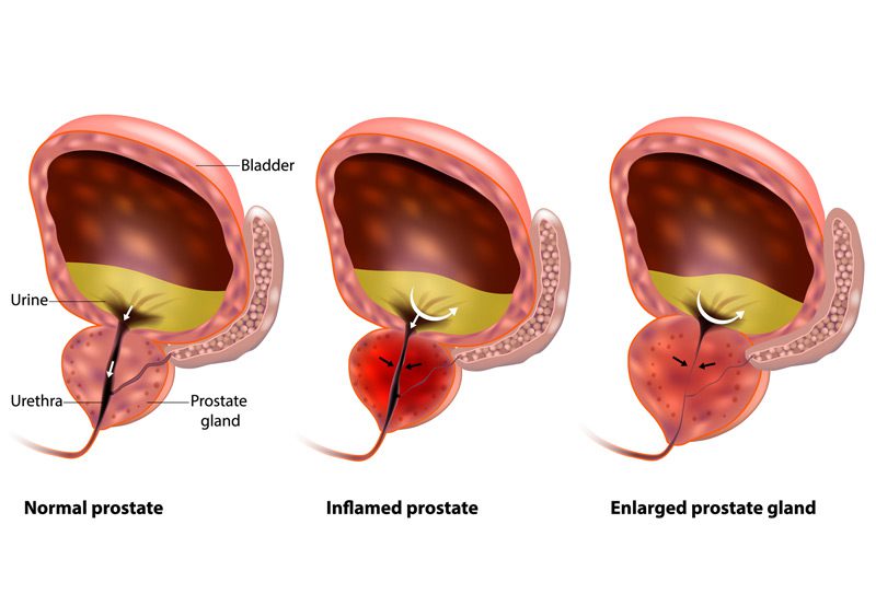 Vector-illustration-showing-benign-prostatic-hyperplasia