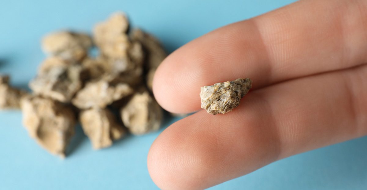 Woman-holding-kidney-stone