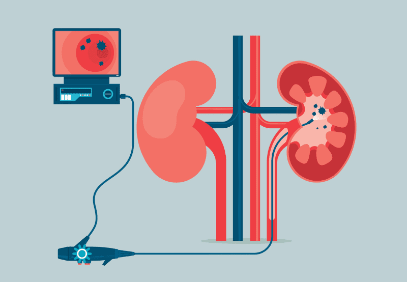 illustration depicting ureteroscopy procedure