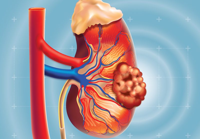 illustration of kidney cancer