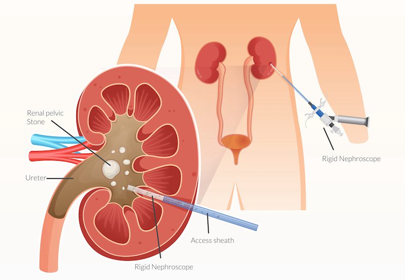 illustration of nephrolithotomy