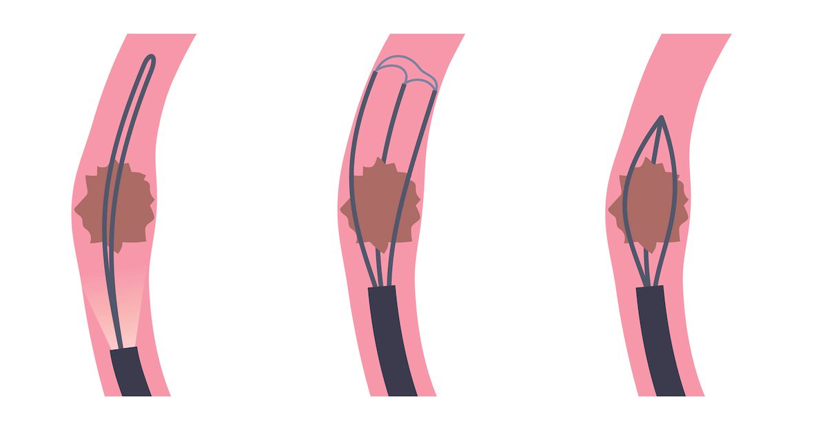 illustration of ureteroscopy steps