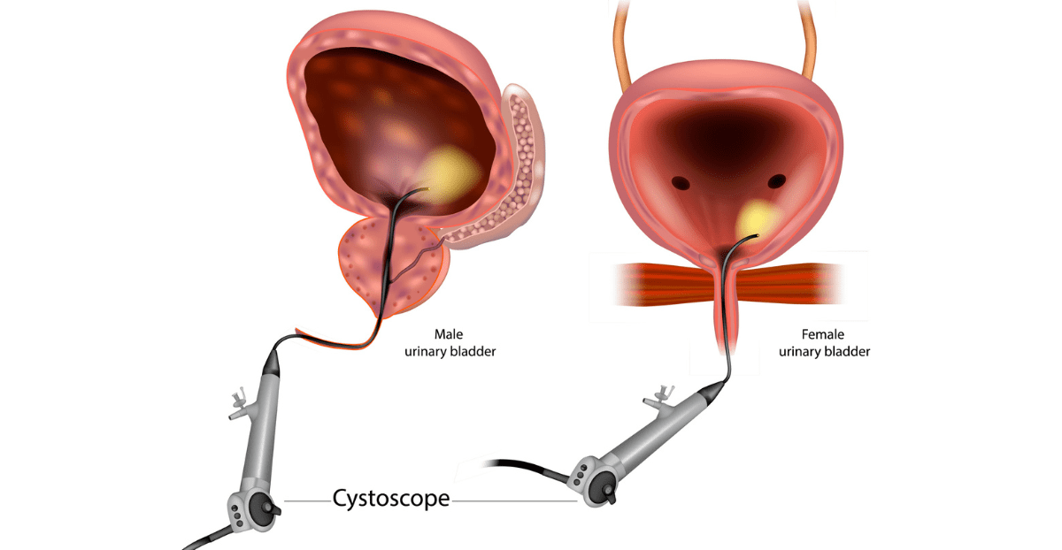 illustration showing cystoscopy of bladder