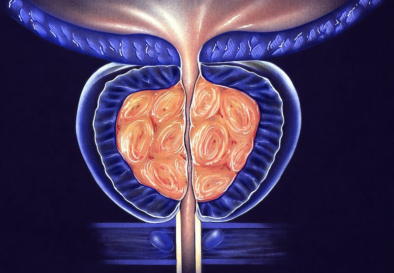 illustration showing enlarged prostate gland