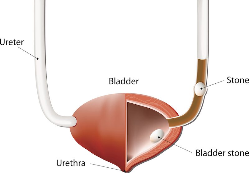 illustration showing where bladder stones occur