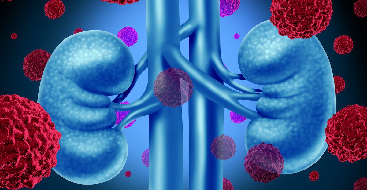rendering of kidney cancer concept